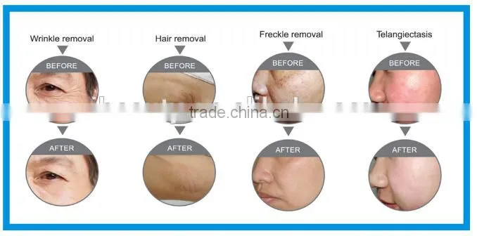 shr ipl hair removal machine/super hair removal/ipl shr +elight