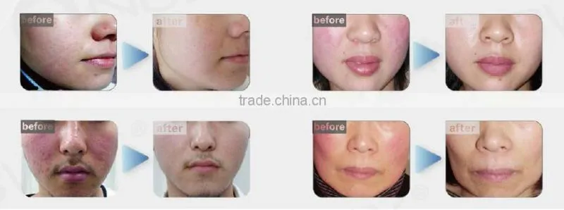 RBS 30MHz Skin Mole Removal Machine / Vascular Vein Removal Machine