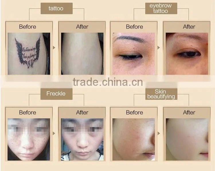 Q-Switch Nd Yag Laser Tattoo Removal System/Q Switched Laser For Tattoo Removal