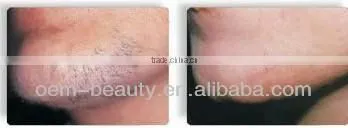No side effects laser treatment hair removal machine