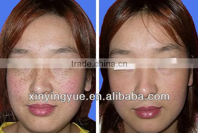 Newest Protable SHR 2 handles Hair Removal OPT IPL RF Facial Whitening