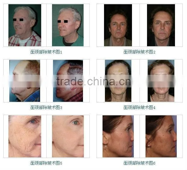 Newest RF for Face Slimming Facail Care Beauty Machine BD-SP002