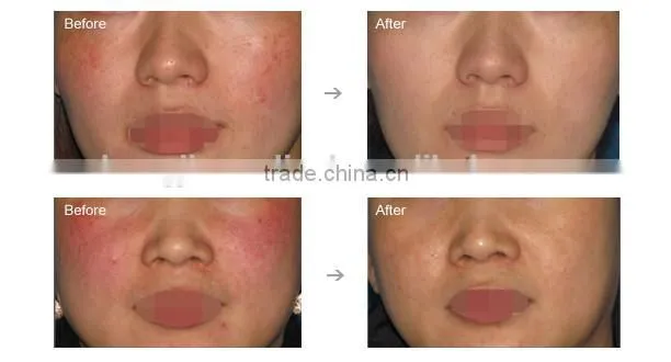 Portable High-frequency Blood Vessels Removal Beauty Machine for skin health with CE certification