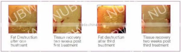 HIFU Body Fat Slimming! Professional Hifushape machine personal body care new hifu