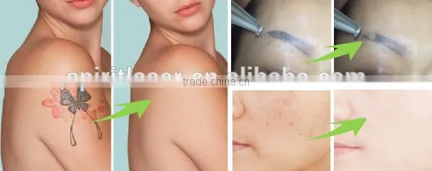 Spiritlaser fda approved laser tattoo removal machine price yag laser head