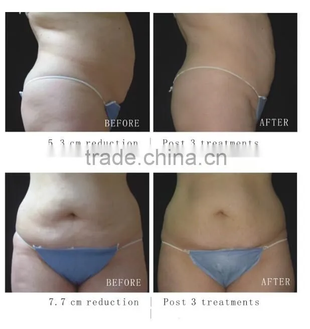 New technology professional HIFU ultrashape machine for slimming weight loss