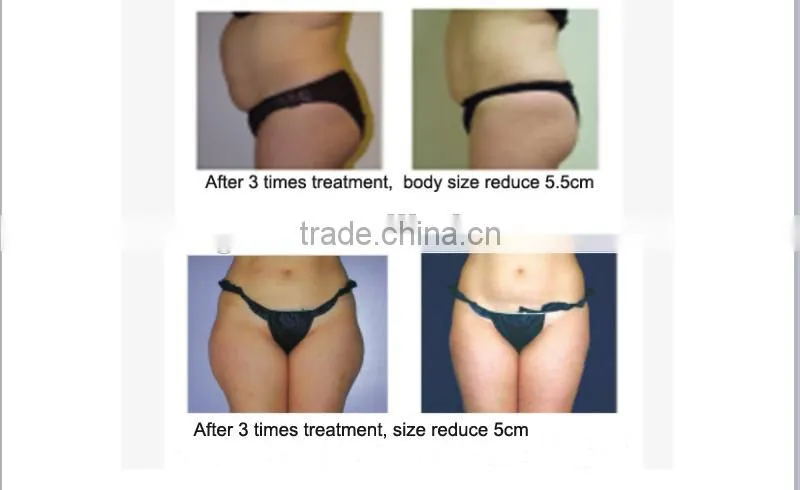 New focused ultrasound slimming machine weight loss slimming body shaping