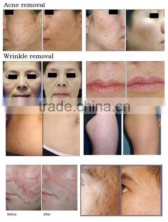 laser facial machine co2 surgical laser manufacturer