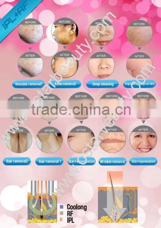 2015 hotsale!! Elight for all kinds of hair removal and skin care equipment (Ostar Beauty Factory)