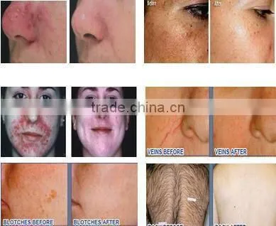 Bottom price cheapest lumea ipl hair removal system