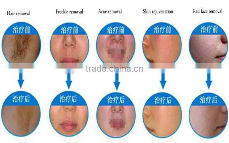 Spider veins and acne removal machine zeno with laser cost for home remedies