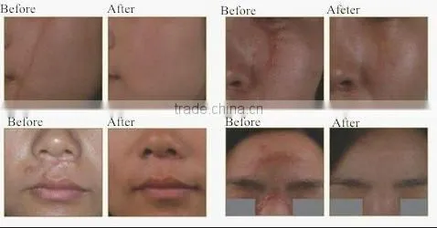 2016 Newest verginal co2 fractional laser skin treatment machine