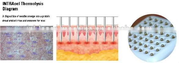 Fractional rf microneedle scar removal/fractional rf microneedle stretch marks removal/fractional rf microneedle wrinkle removal