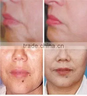 Radio frequence beauty equipment for Wrinkle Remover RF004