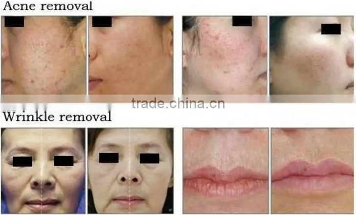 professional skin resurfacing co2 laser