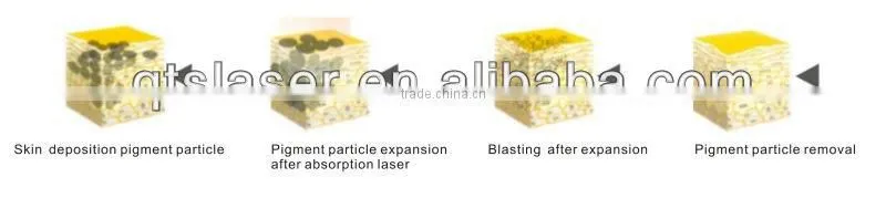 nd yag laser pulsed dye laser for tattoo