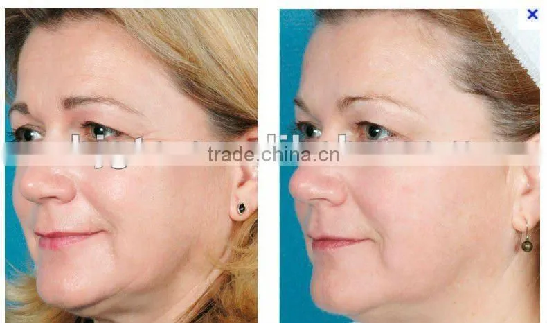 GTO brand 1200 derma roller skin roller body derma roller