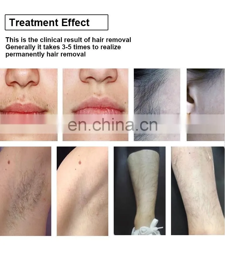 Fashion Design Big Spot Size 808nm Laser Diode Bar/chips 808 Diode Laser Hair Removal Beauty Machine