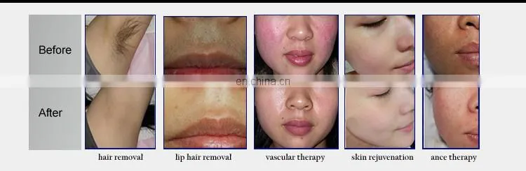 hair removal,skin rejuvenation, skin care--IPL&RF&E-light system