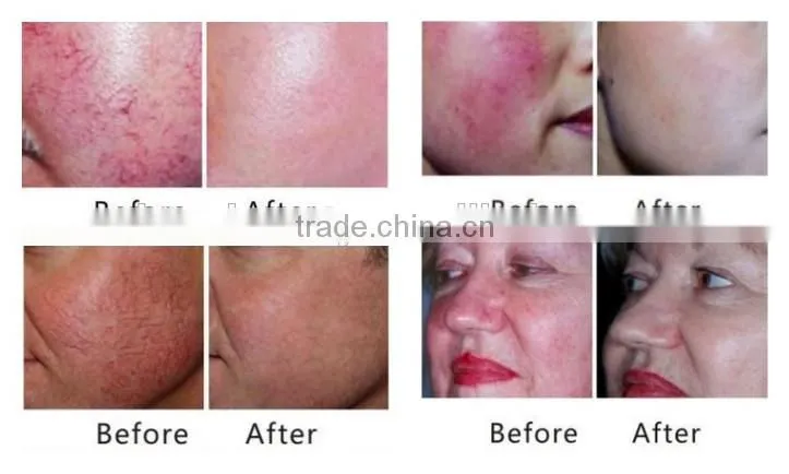 980nm diode laser vascular removal with CE