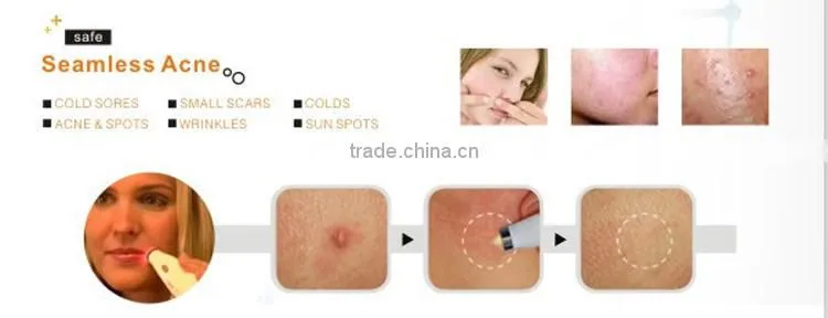 Best effective hot sale soft acne laser removal/acne treatments pen for sale