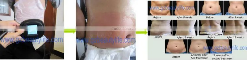 Fat freezing cryolipolysis machine/Professional cryotherapy equipment fat removal