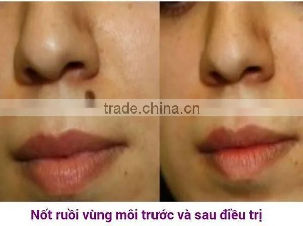 2016 Professional tattoo removal laser machine q-switched nd yag laser/nd yag laser prices/cosmetic nd yag laser machines prices