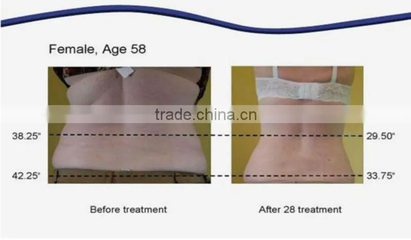 guangzhou supplier lipo laser slimming machine for reduce fat