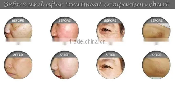 hair removal skin rejuvenation IPL laser machine