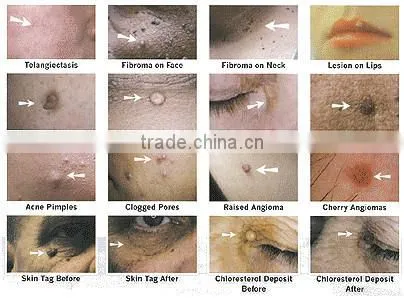 Instaneous High frequency facial mole removal