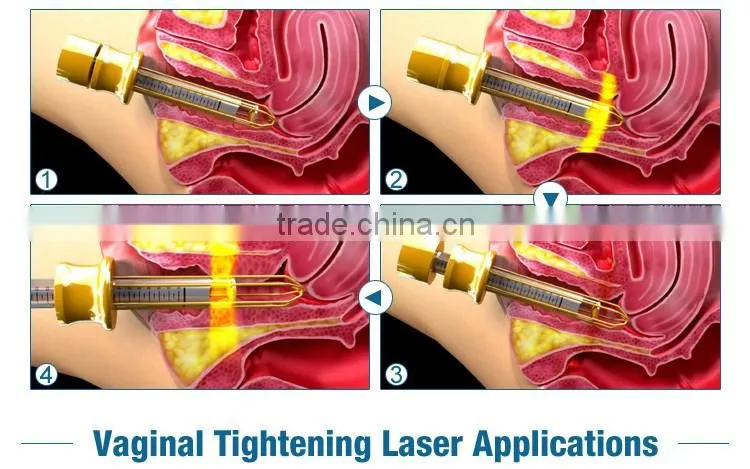 Professional vaginal tightening machine co2 fractional laser treatment for face and body