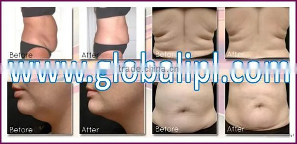 Most effective ultrasound therapy machine for physiotherapy