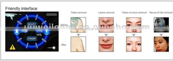 Q-switched ndyag laser,professional for tattoo,pigment ,eyebrow removal