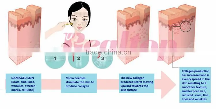 Realtop medical grade dermaroller derma roller 540 microneedling pen / meso needles for skin whitening pigment removal