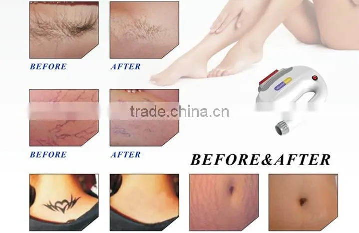 Multifunctional Elight IPL RF Nd Yag Laser Tattoo Removal Hair Removal Beauty Salon