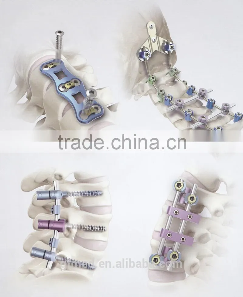 I type Eternal fixation surgical instruments Spinal Implant For Rf Spinal Fixation System
