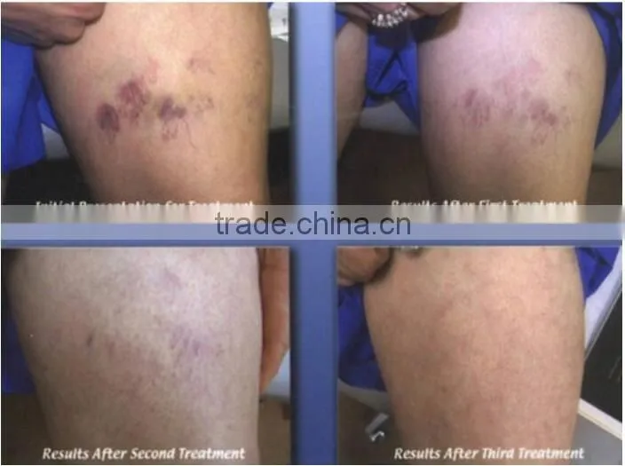 Diode laser 980nm vascular machine for spider vein removal