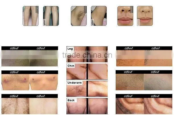 New products best hair removal machine 808nm diode laser hair reduction wanted 2016