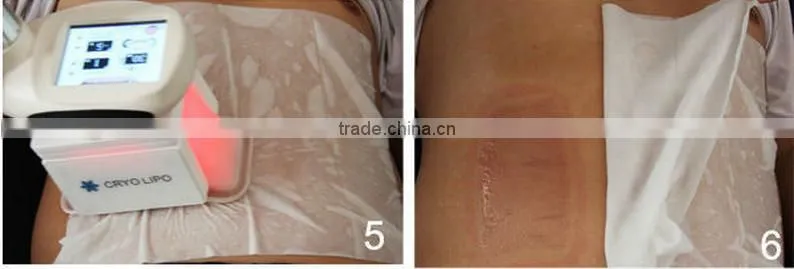 2016 Beauty machine for criolipolisi 5 head cryo