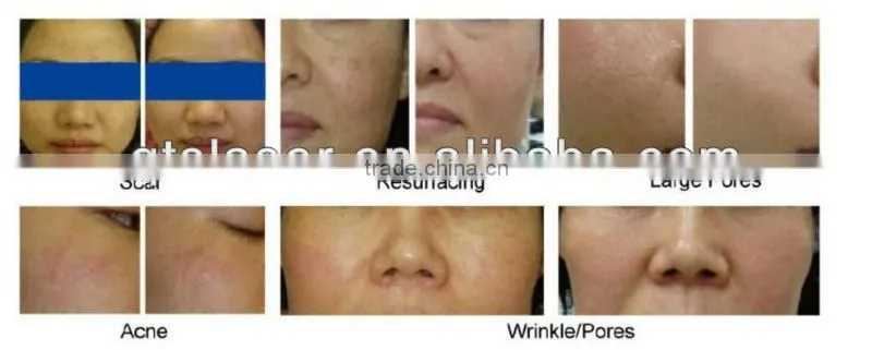 RF co2 fractional laser for brown spots removal laser machine