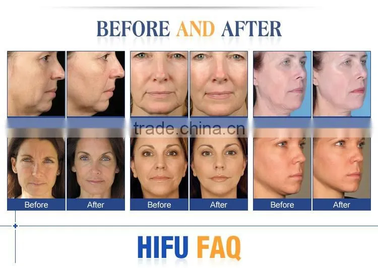 High Intensity Focused Ultrasound Hifu/ Hifu Anti-wrinkle With Amazing Effect