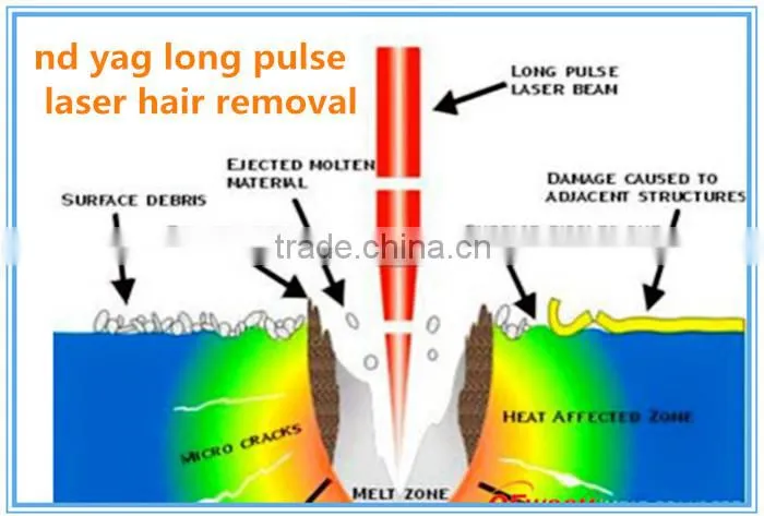 CE Approval Long pulse 1064nm nd yag laser permanent hair removal and Spider Vein removal