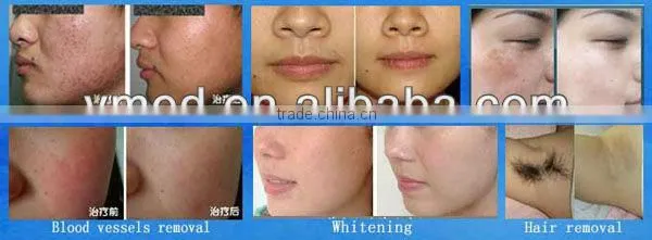 Hair loss Near Hongkong/Hot hair removal IPL +RF