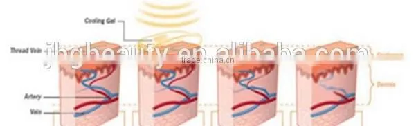Good price blood vessels removal 980nm diode laser spider vein removal machine