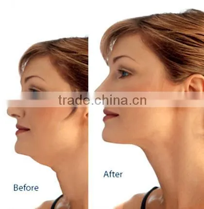 Joyful freezing fat cell slimming cryolipolysis machine