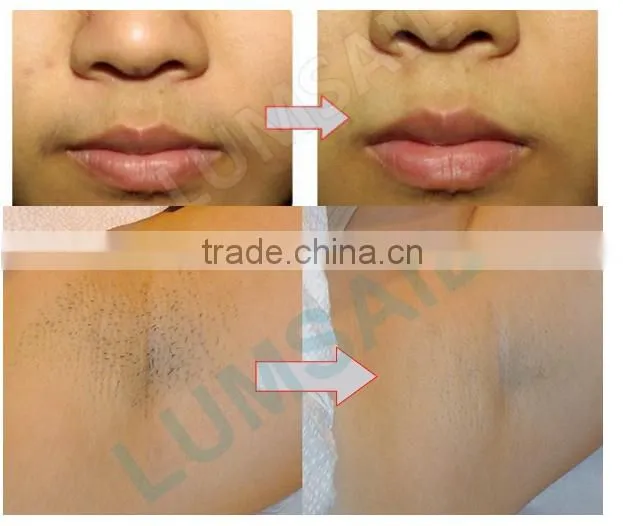 painfree shr ipl hair removal machine beauty equipment