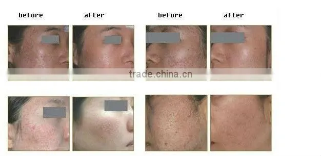 2013 Pixel Co2 Fractional Laser 30w/ Medical Laser Equipment --- Co2laser