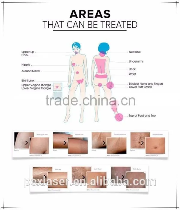 Portable diode laser hair removal equipment 808nm diode laser