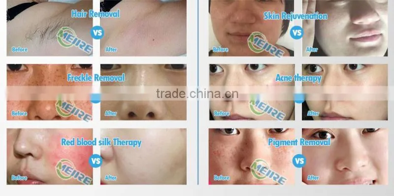 New design ipl shr opt laser permanent home medical device