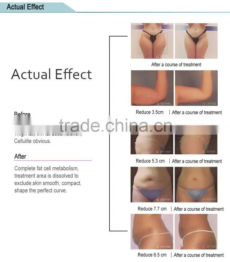 Ultrasound Shape with new slimming technology machine